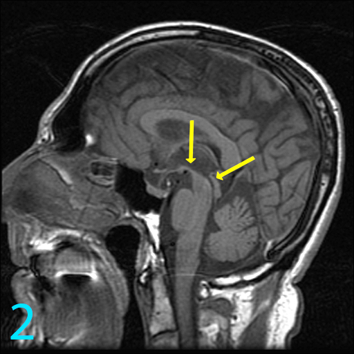 Is Brain Humming Real? Deceptology