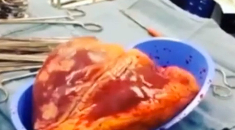 Cocaine addict's heart 'beats' for 25 mins after removal (VIDEO) — RT