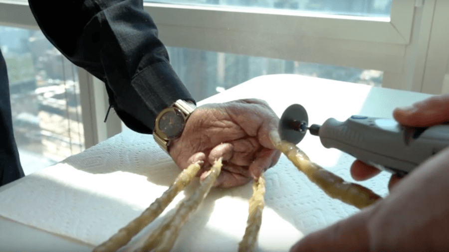 Indian man with world’s longest fingernails has them clipped & put on