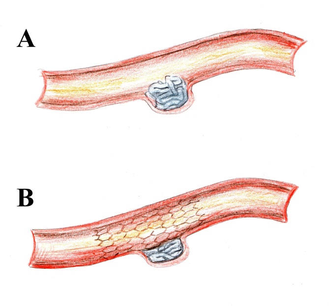 StentAssisted Techniques for Intracranial Aneurysms IntechOpen