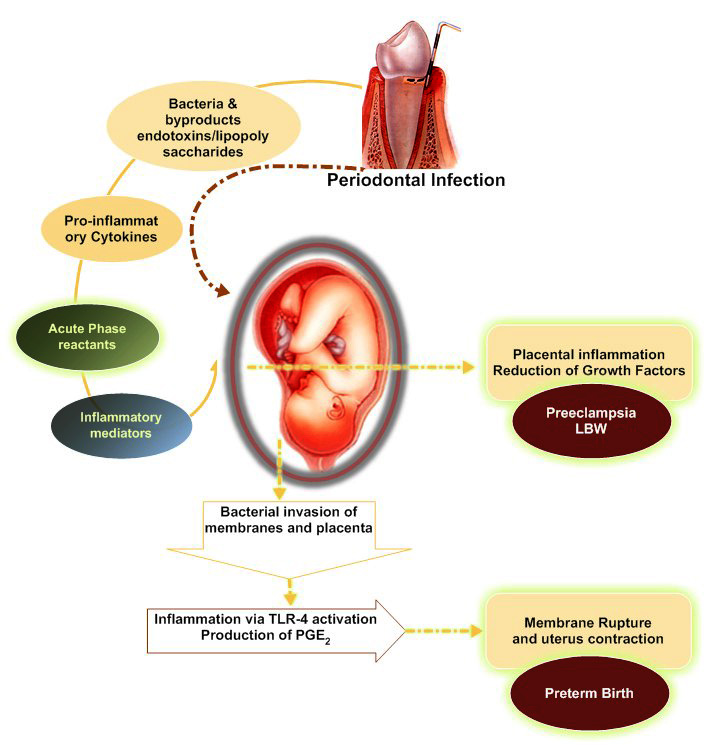 Oral Health and Adverse Pregnancy IntechOpen