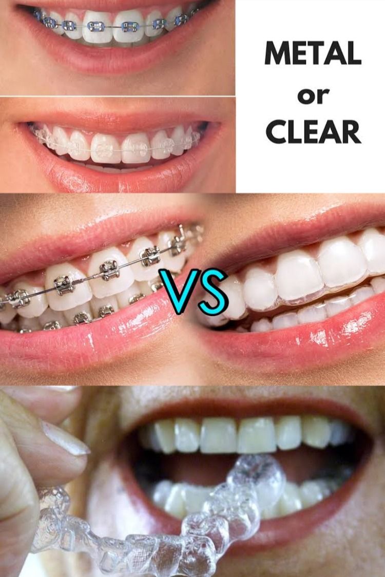 3 Ways To Prevent Staining With Ceramic Braces TTAPP