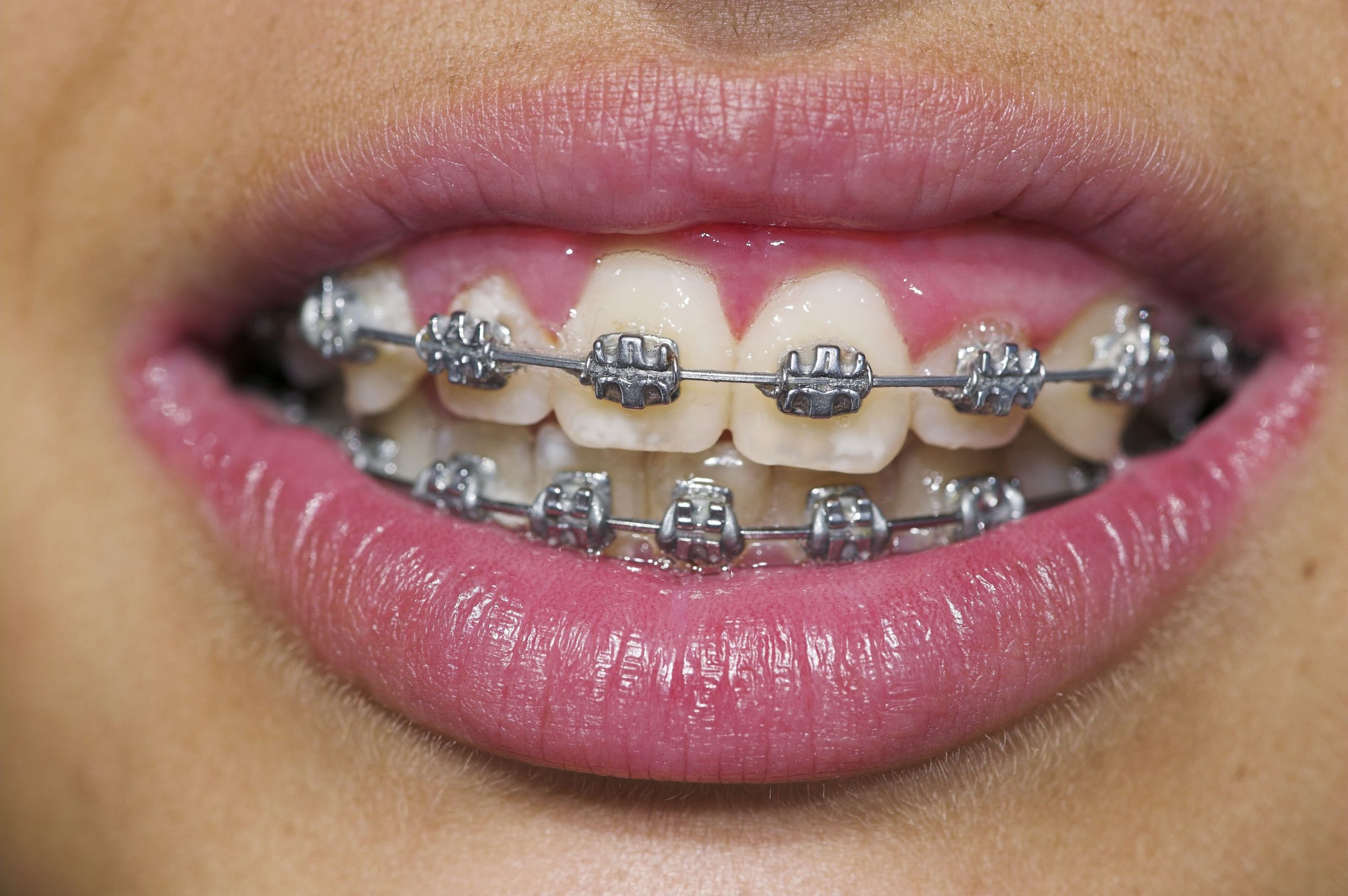 The Cheapest Types Of Braces TTAPP