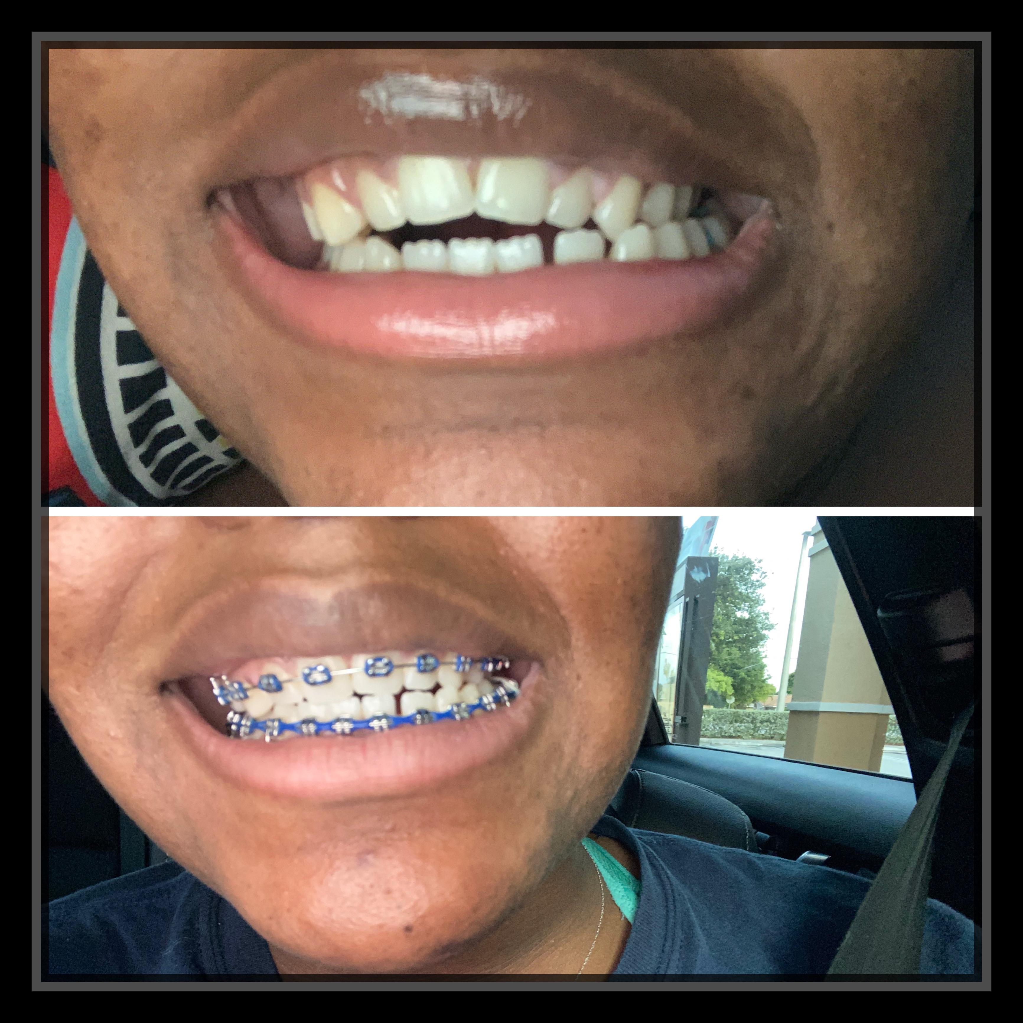 The Truth About Braces They Only Move Your Teeth Slow TTAPP