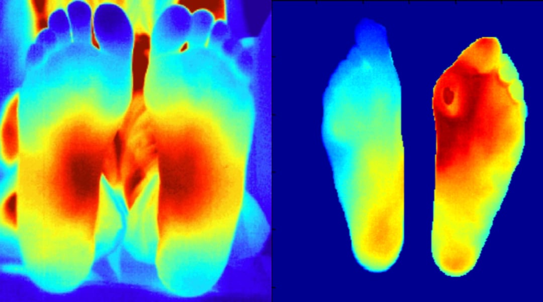 Sensores de temperatura para detectar el pie diabético Éndolum CDyTE