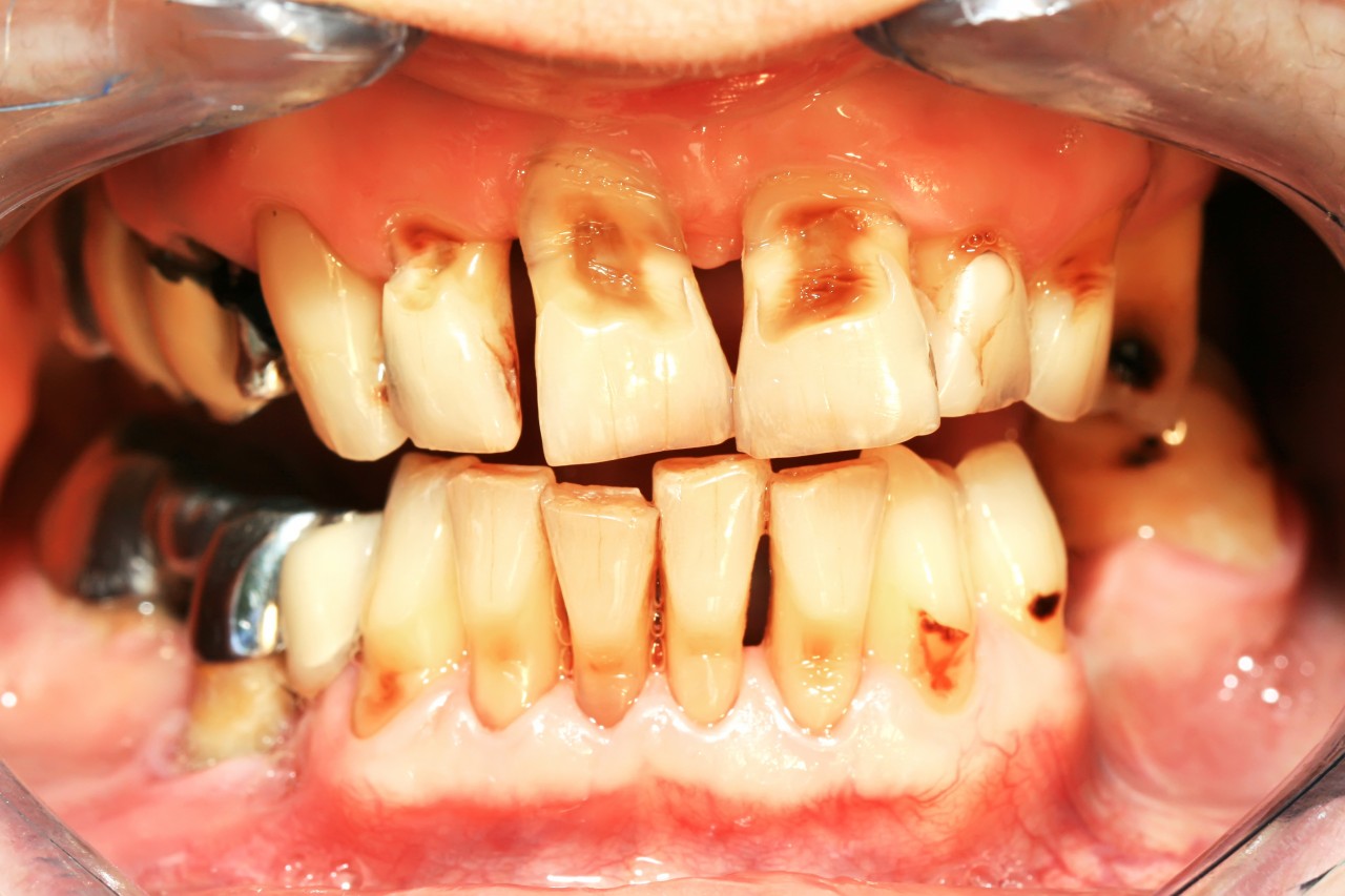 Cavity teeth problem in Cebu Philippines