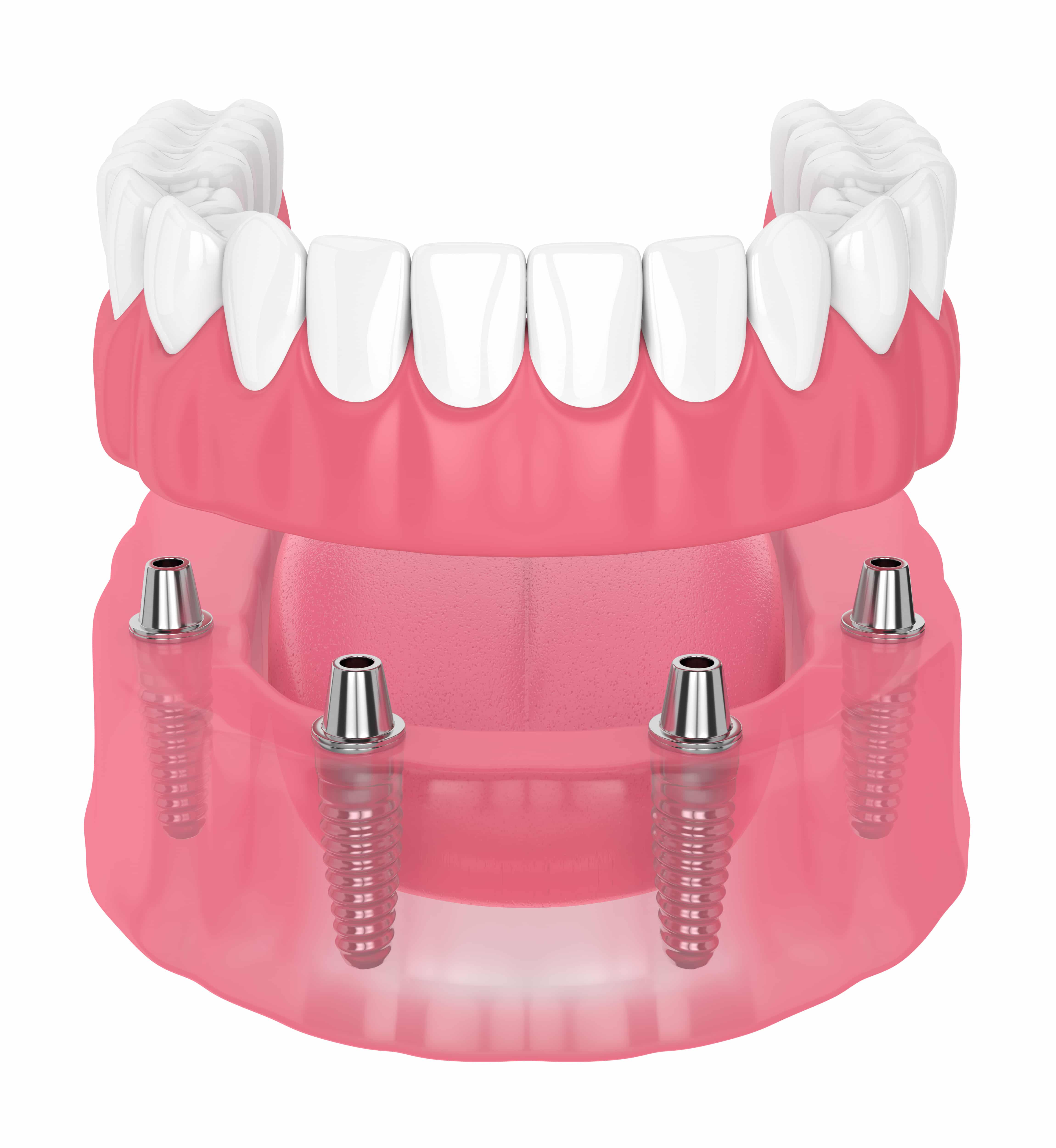 Richfield Dentist Addresses Tooth Loss With A Full Denture Richfield, MN