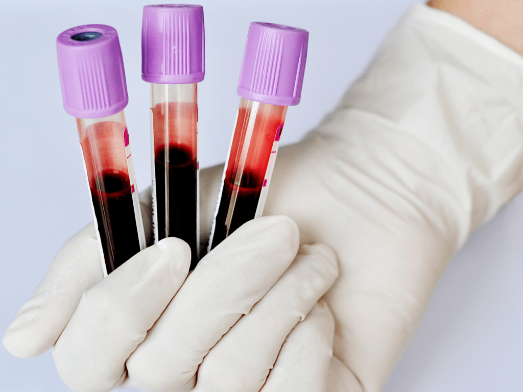 Plasma rico em plaquetas (PRP) o que é e como funciona?