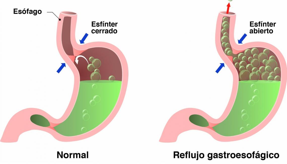 ¿Qué es el reflujo gastroesofágico? CEGA