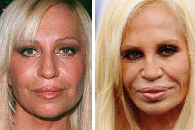 Donatella Versace Facelift Plastic Surgery Before and
