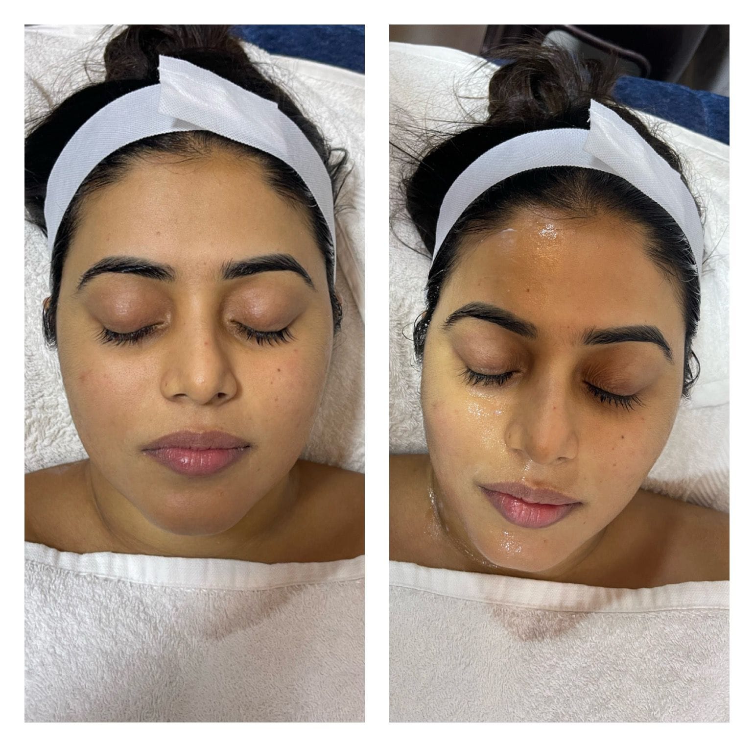 Laser Hair Removal Treatment Celebrity Secrets