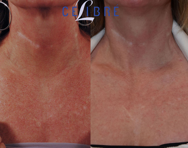 Treatment of Poikiloderma