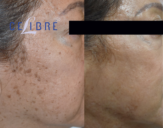 What is Dermatosis Papulosa Nigra and How Is It Treated?