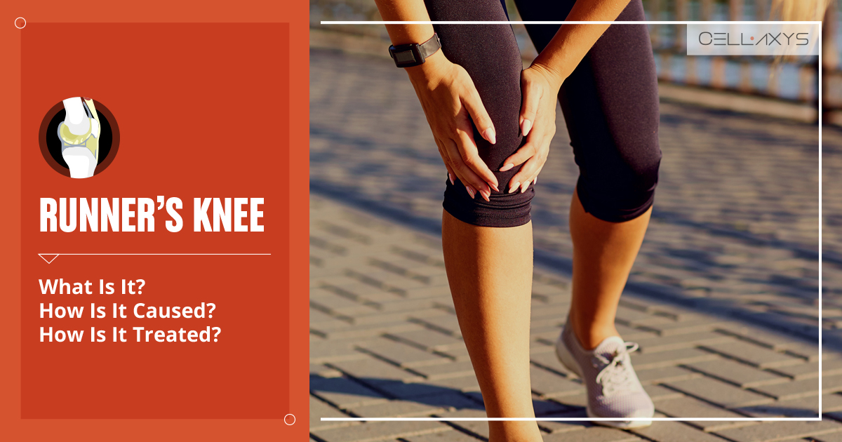 Runner’s Knee What Is It? How Is It Caused? How Is It Treated? Cellaxys