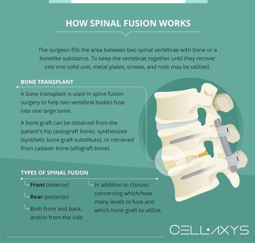 Spinal Fusion Surgery Cellaxys