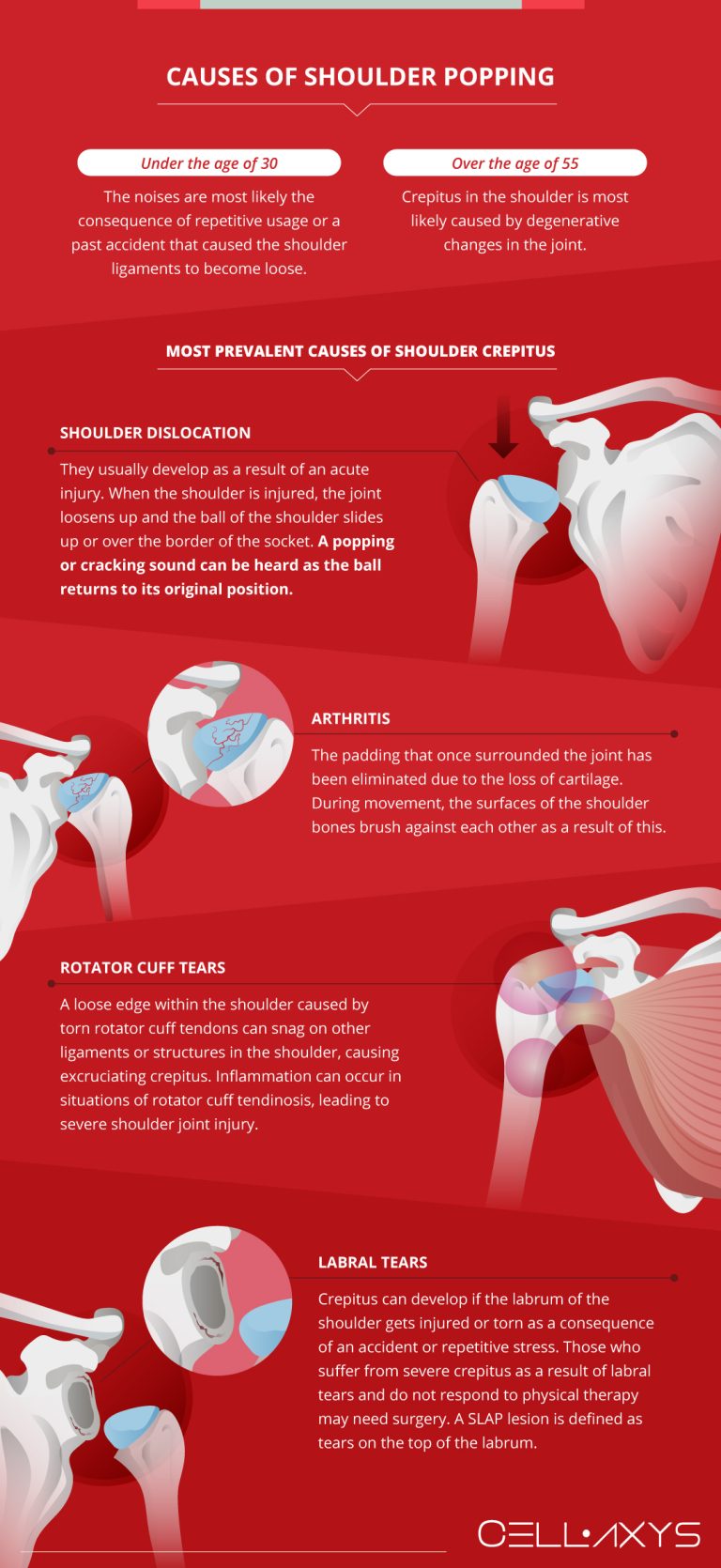 Causes Of Popping Noise In The Shoulder Cellaxys