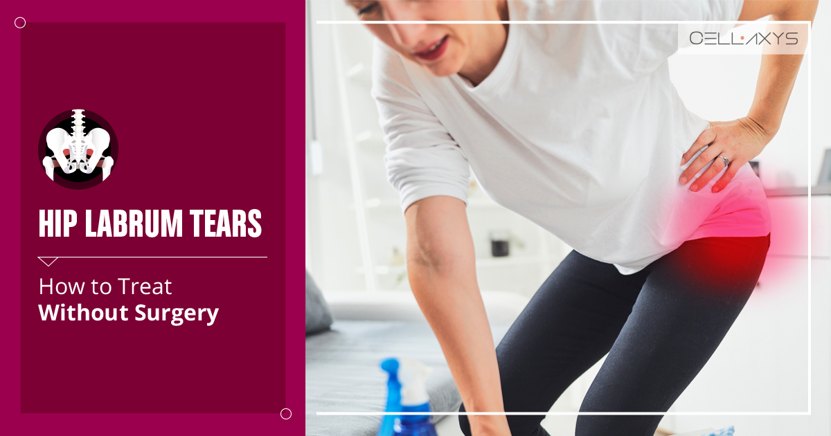 Hip Labrum Tears How To Treat Without Surgery Cellaxys