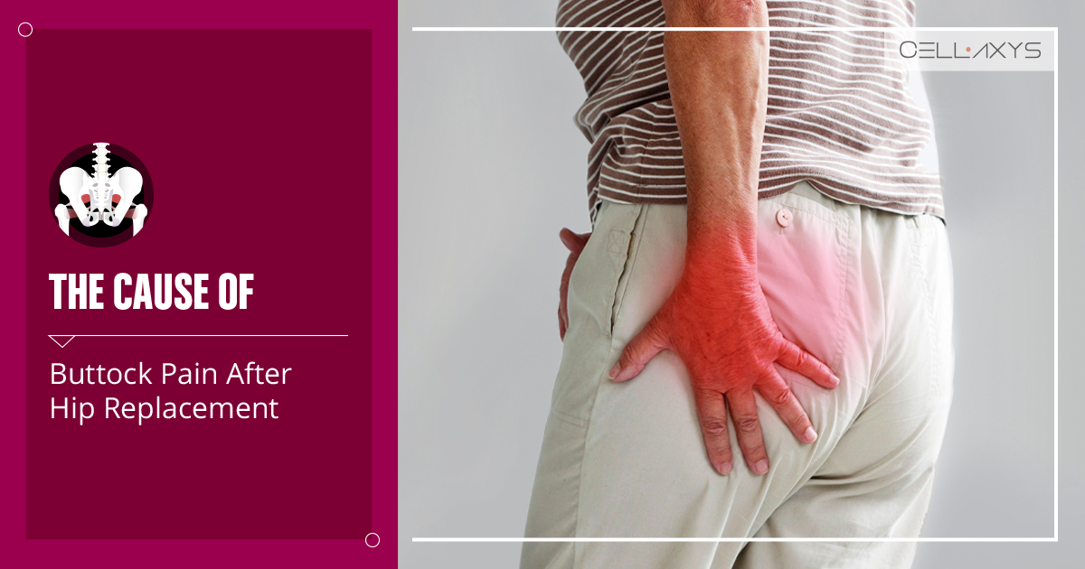 The Cause Of Buttock Pain After Hip Replacement Cellaxys