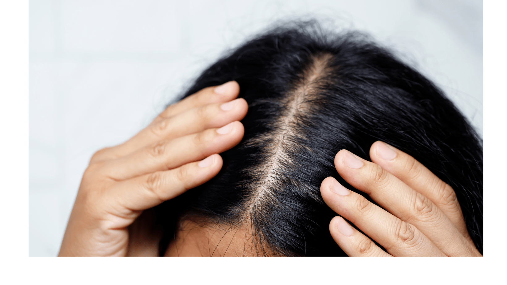 Hair Loss Can Folliculitis be the Cause? Cellustrious