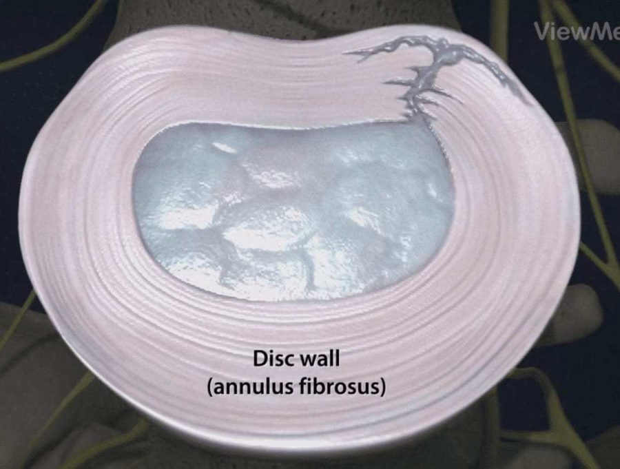 Annular Tear Treatment Regenerative Stem Cell Therapy Blog