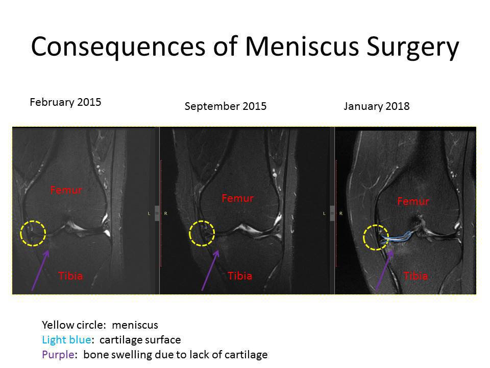 Meniscus Surgery Consequences Progression of Knee Arthritis