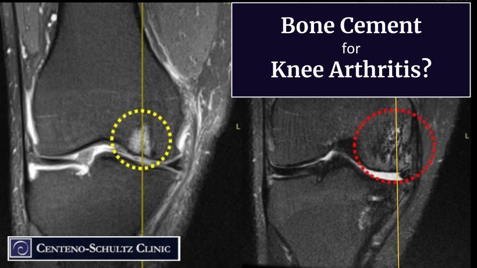 Does Bone Cement Injection Work for Arthritic Knees?