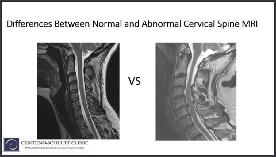 Differences Between a Normal vs Abnormal Cervical Spine MRI