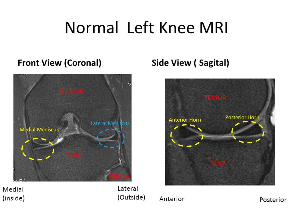 Knee Meniscus Understanding Your Knee MRI Stem Cell Blog