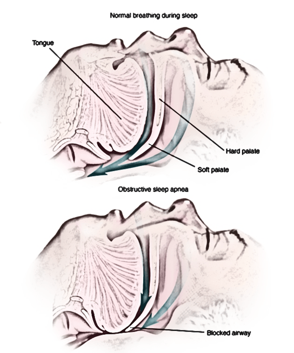 Aging Athlete Series Episode 5 Do You Snore? CSC