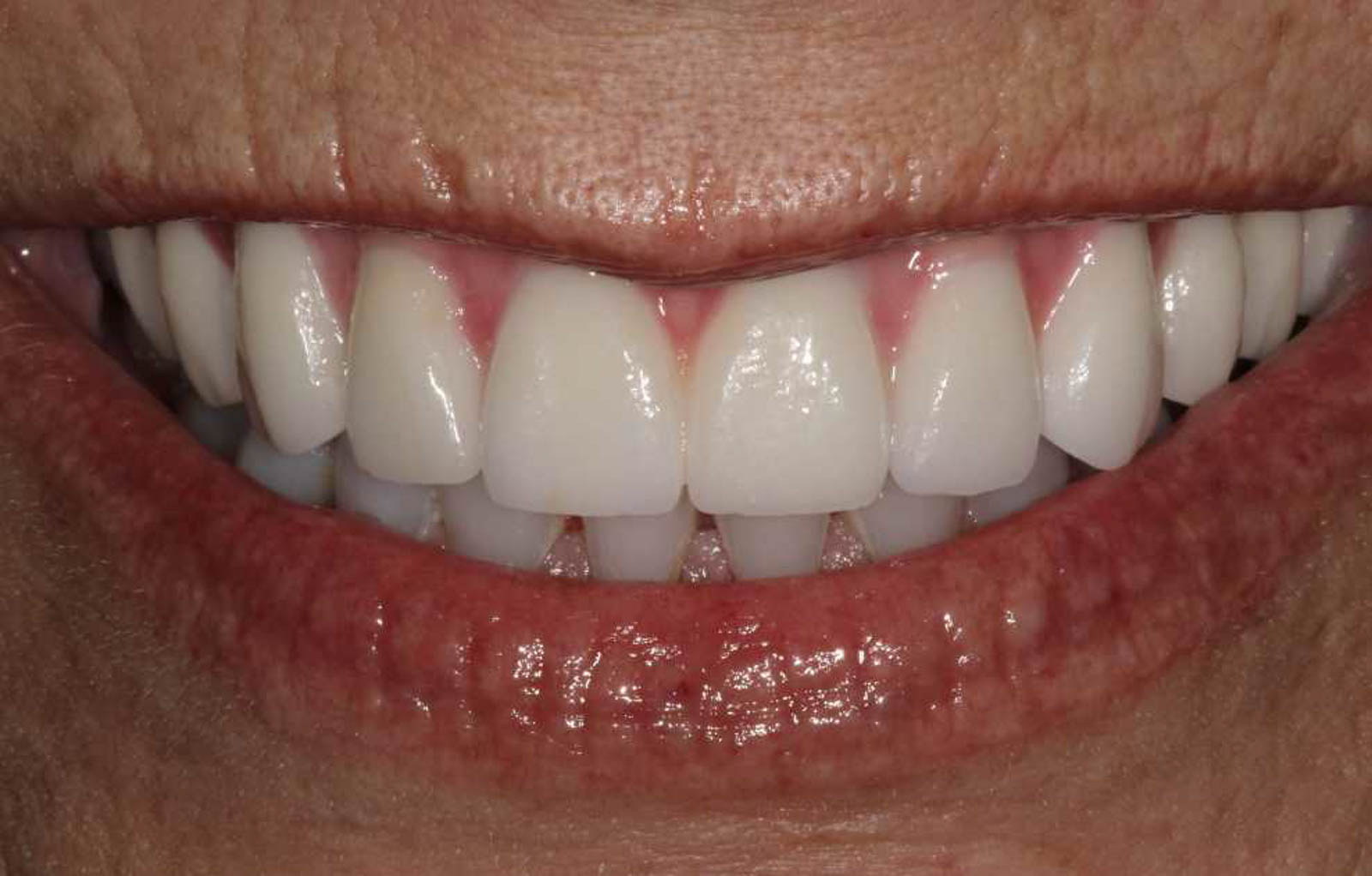 Single Implant Photo Gallery Dental Implants by Center 4 Smiles