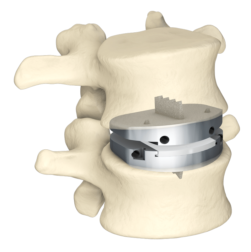 Centinel Spine Announces that UnitedHealthcare Will Now Cover prodisc L