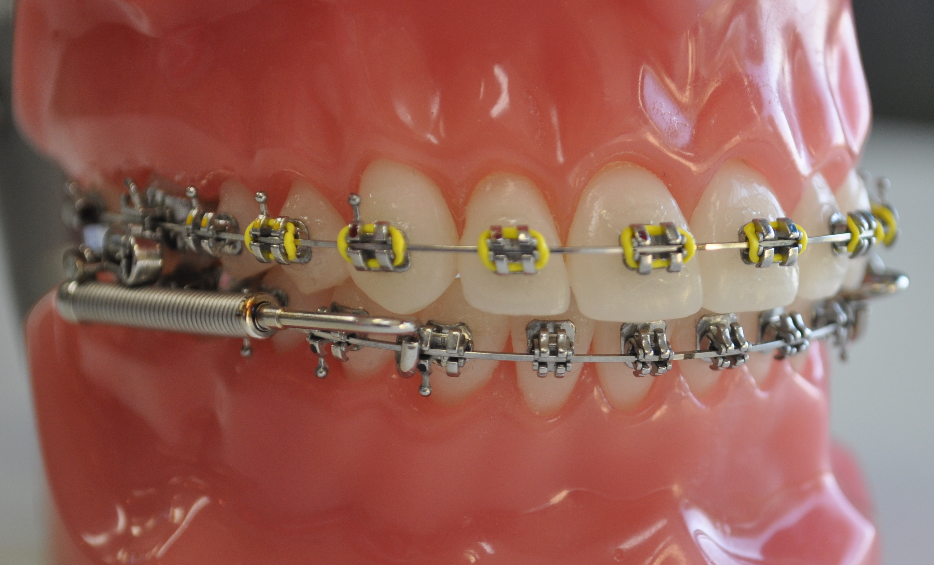 Traditional Braces CENTRAL ALBERTA ORTHODONTICS' BLOG