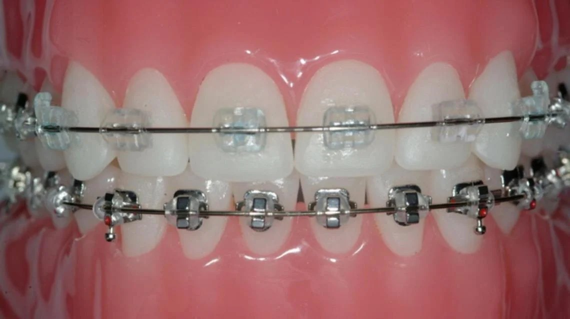 Ceramic Braces Vs Metal Braces