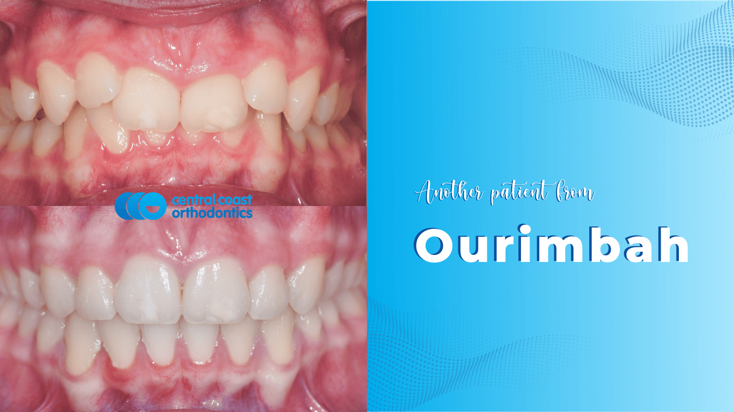 Braces in Ourimbah Central Coast Orthodontics
