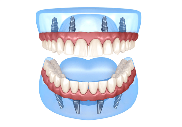 Implant Hybrid Dentures Central Coast Smiles