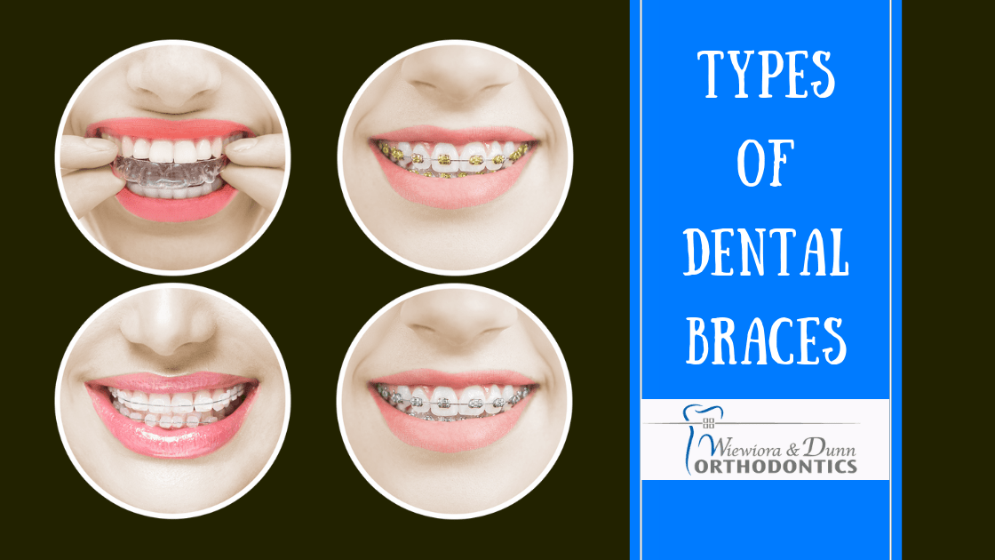 Which Type of Braces is Right for You Wiewiora & Dunn Orthodontics