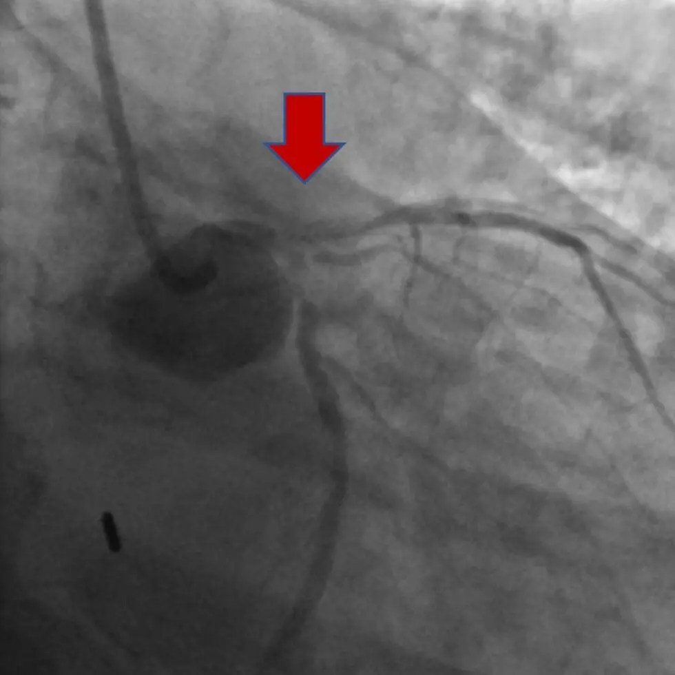 Coronary angioplasty or stenting Central Heart