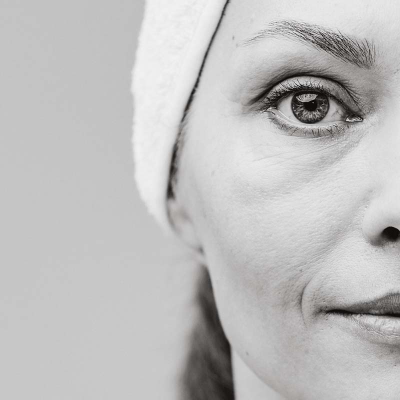 Cheek Volume Loss Central Wellness Medical & Aesthetic