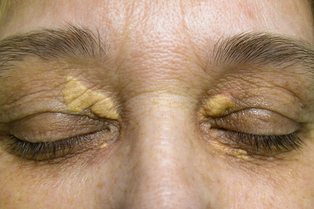 xanthelasma removal clinic near me weihlmezquita99