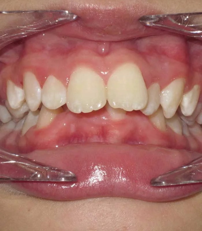 Overjet Orthodontist Ottawa ON Centrepointe Orthodontics