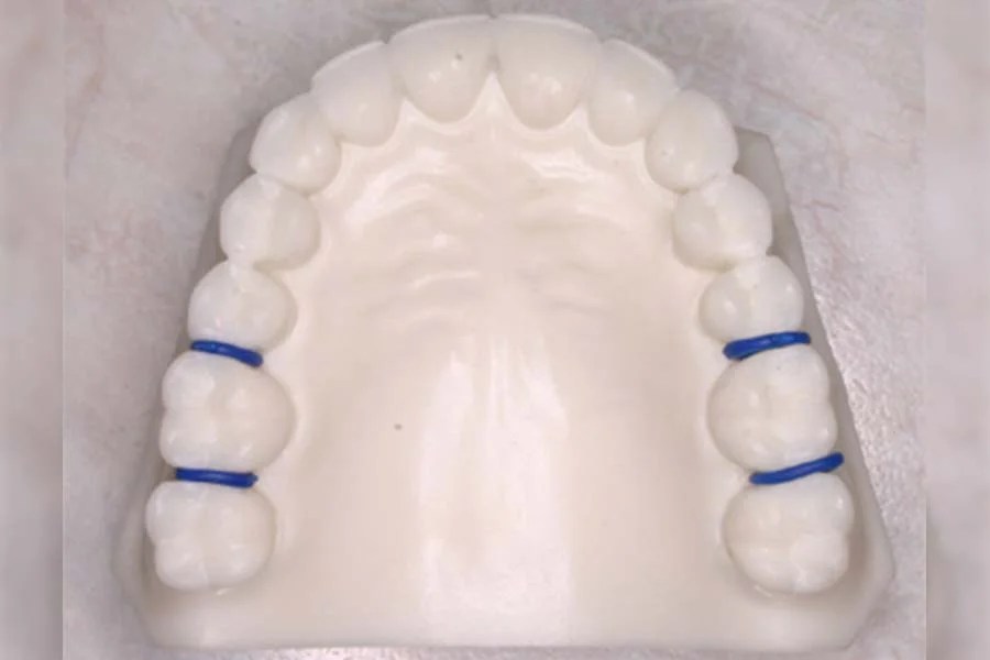 Separators or Spacers Orthodontist Ottawa ON Centrepointe Orthodontics