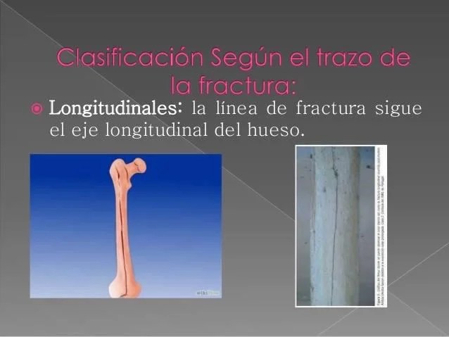 Fracturas por Rx. Centro de Diagnóstico por Imágenes