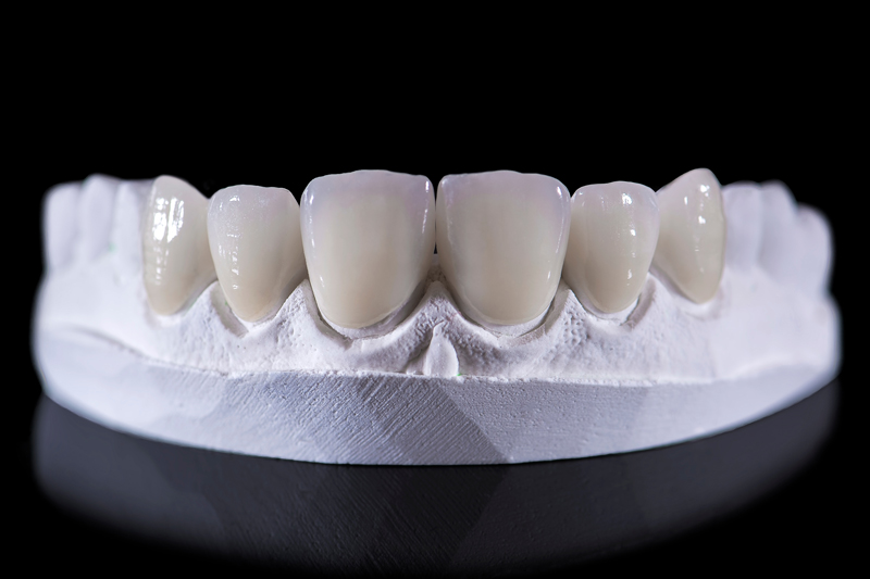 All Ceramic Crowns CeraTech Dental Lab