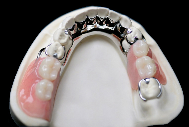 Full and Partial Removable Dentures - Cera-Tech Dental Lab