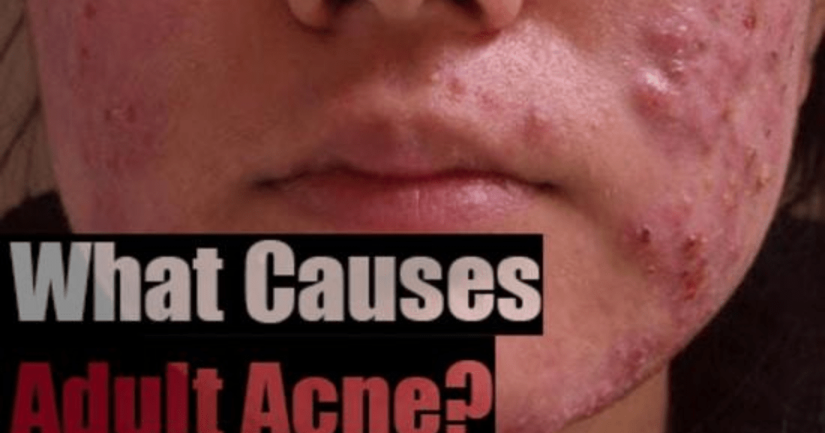 How To Get Rid Of Adult Acne GirlsAskGuys