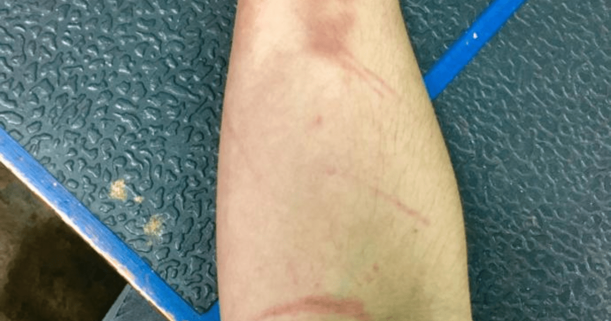 Why do I bruise so easily? Does anyone else bruise this easy
