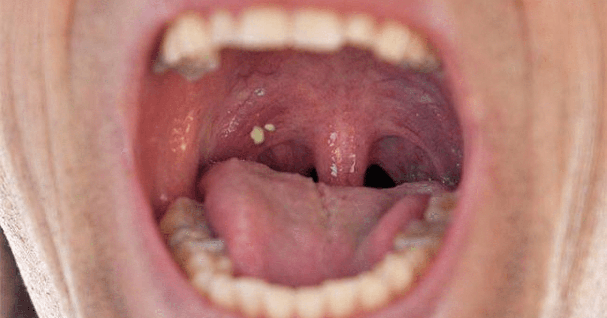 Increased amount of tonsil stones? GirlsAskGuys