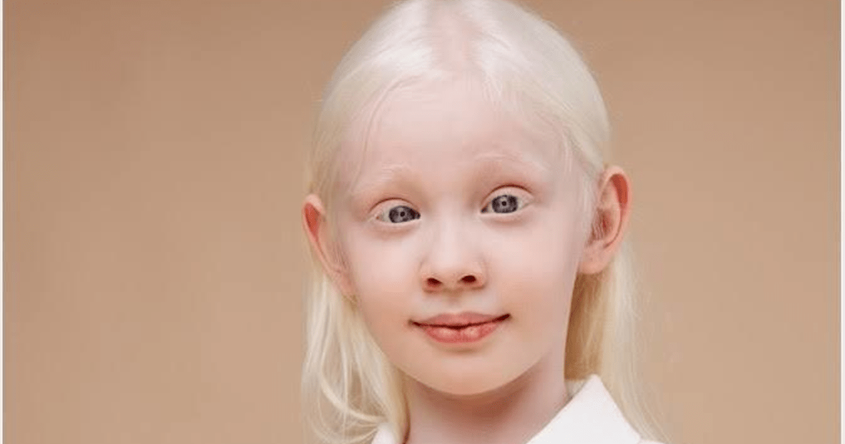 Why do Scandinavians have albinism? GirlsAskGuys