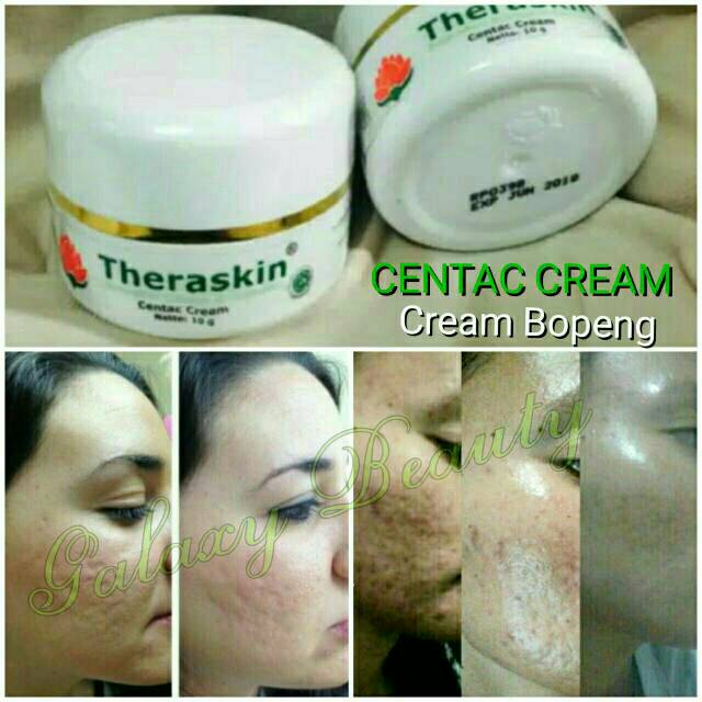 Cream Menghilangkan Bopeng Bekas Jerawat Yang Sudah Lama
