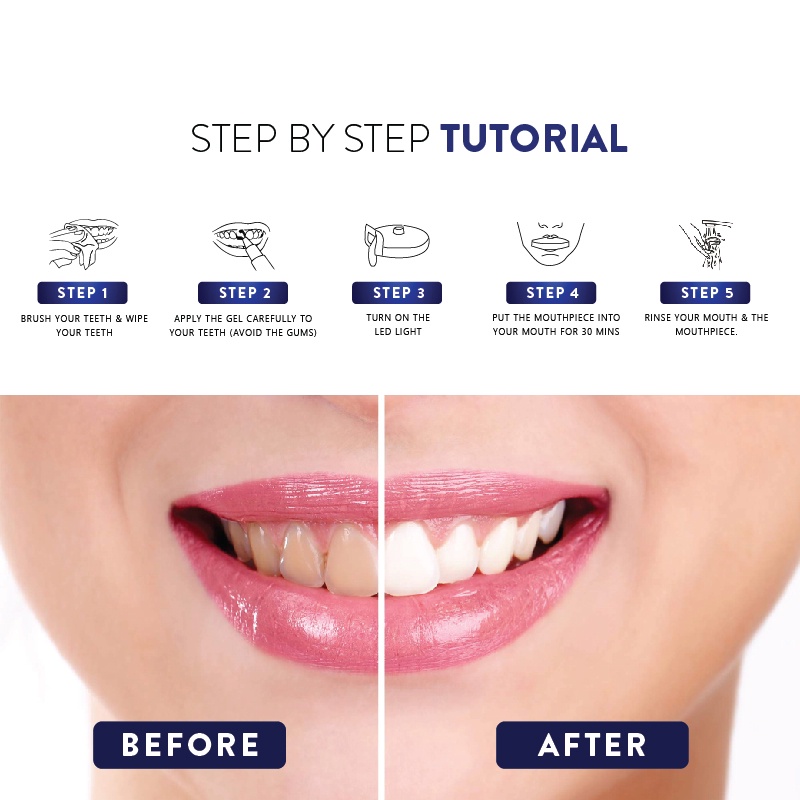 Top Products In Teeth Whitening 2023 Jual Beaudelab Professional Teeth Whitening Pen Bpom | Professional Pen Pemutih Gigi Indonesia|Shopee Indonesia